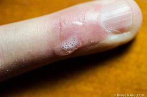 finger with bubbling liquid